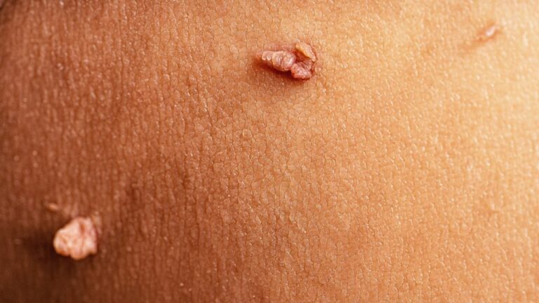 Genital Warts Vs Skin Tags