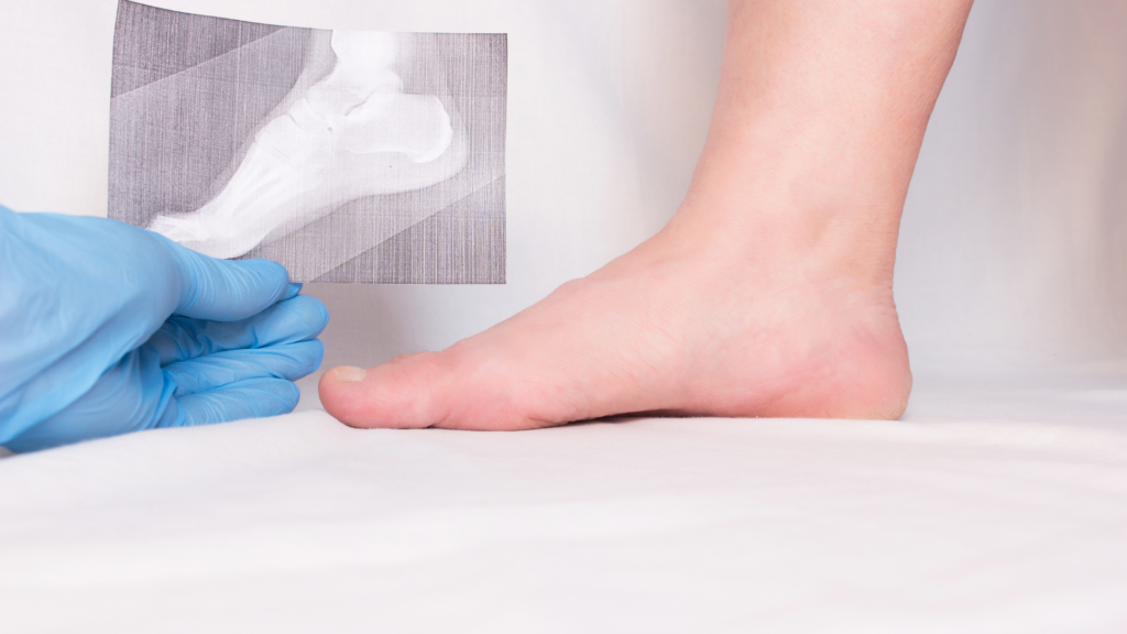 heel spurs surgery recovery time - causes