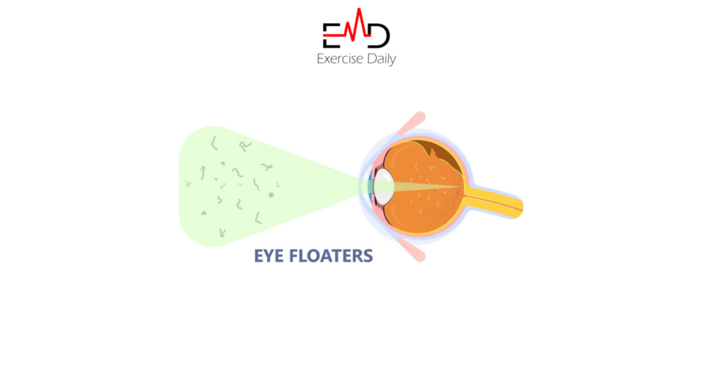 Are Floaters in the Eye Dangerous? Exercise Daily