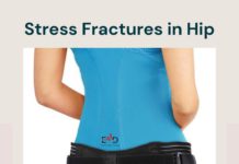 stress fractures in hip