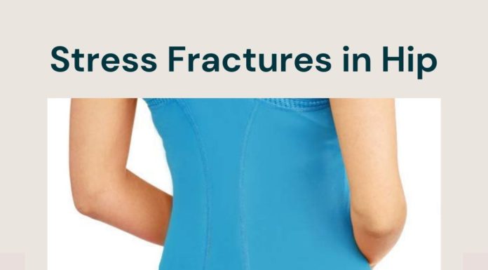 stress fractures in hip