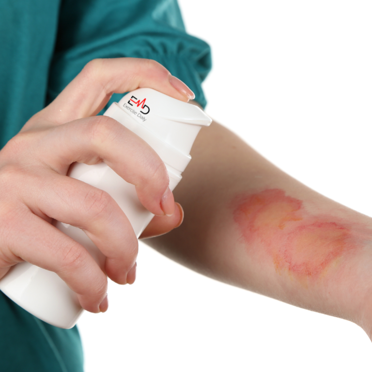 how to treat a burn from a hot pan