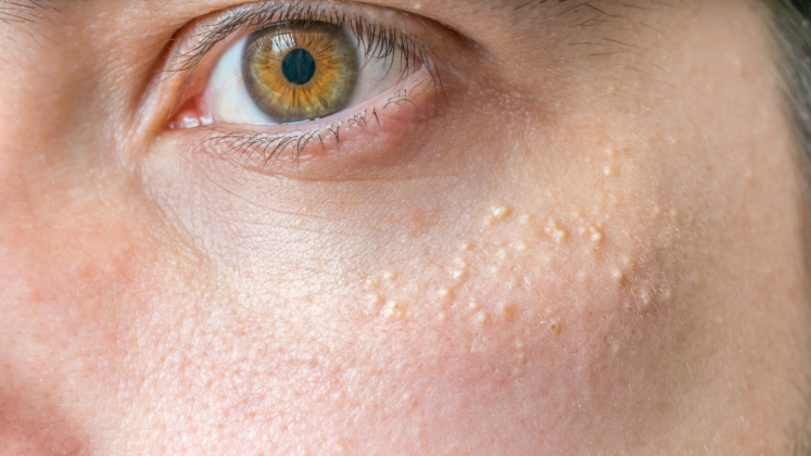 calcium-deposits-on-eyelids-and-skin