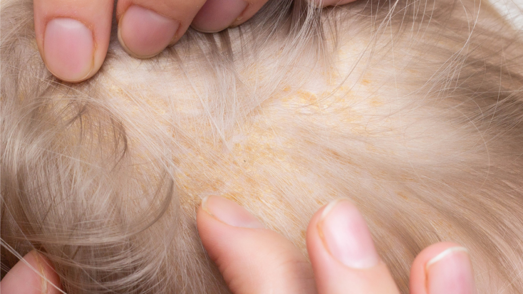 Why Do My Hair Follicles Hurt?