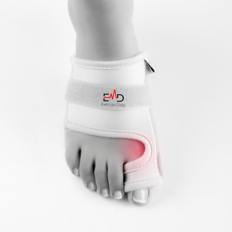 Are Bunions Genetic?