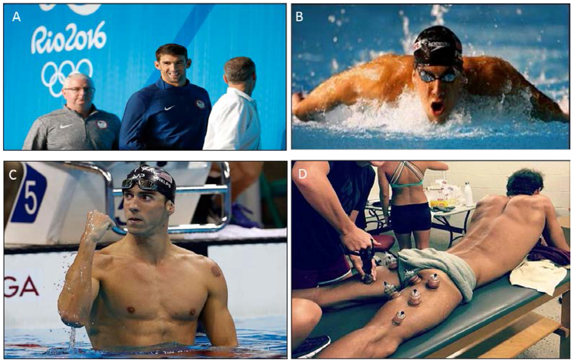 Benefits of Wet Cupping for Athletes
