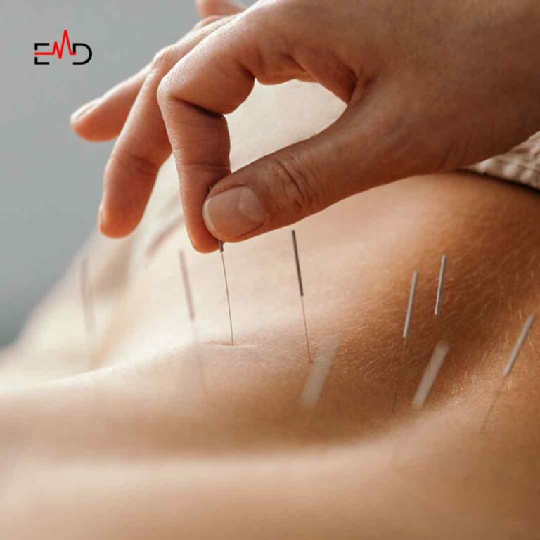 Acupuncture: Benefits, Risks, and How it Works