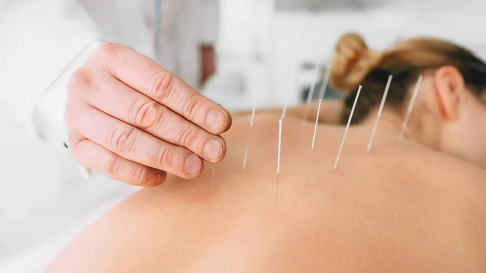 Acupuncture: Benefits, Risks, and How it Works
