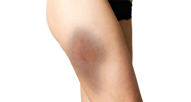 Bruises and Contusions in Basketball