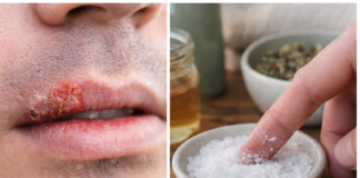 Cold Sore Healing Time: Can Salt Reduce Inflammation and Speed Recovery?